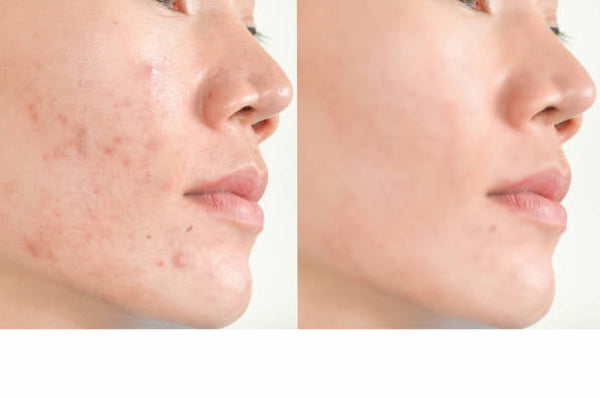 RENEW AHA Facial Toner - Bergamot | Great for Oily Skin or Blemish Prone